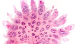 Laki-Laki Juga Rentan Terinfeksi HPV